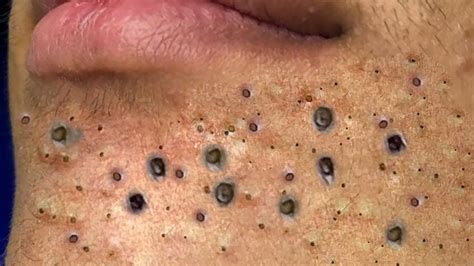 why is blackhead removal satisfying|Why people can't stop watching pimples and blackheads.